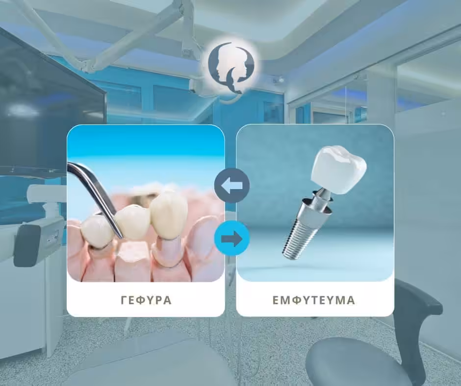 Εμφυτεύματα ή Γέφυρα