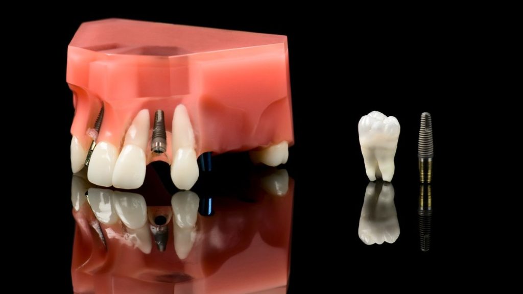 allon6-dental