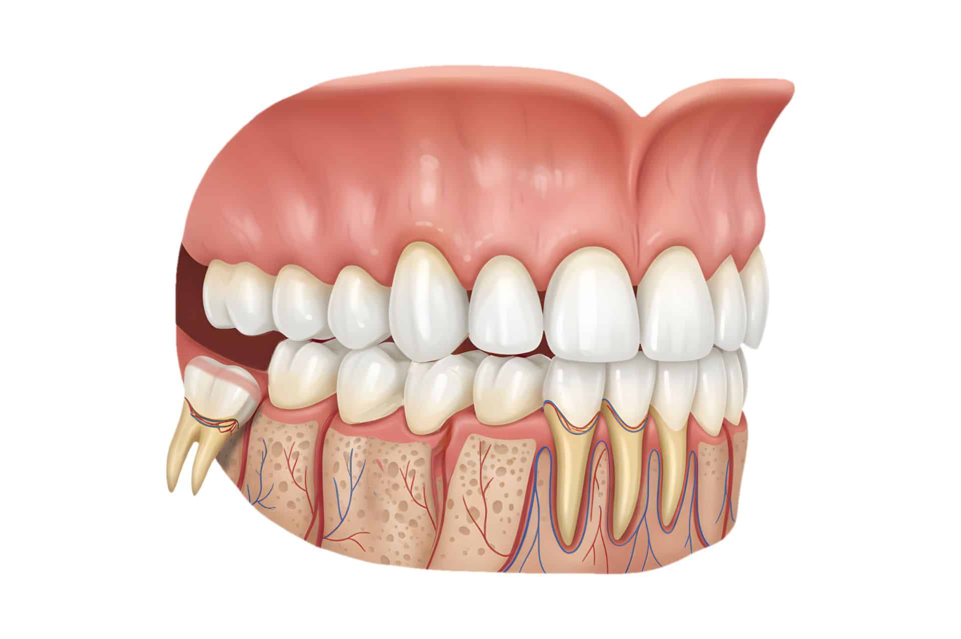 φρονιμίτης προβλήματα