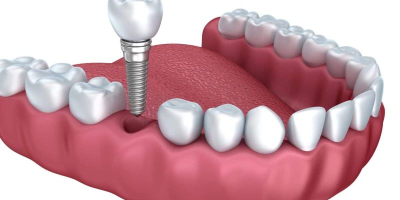 Εμφυτεύματα Δοντιών Φωτογραφίες