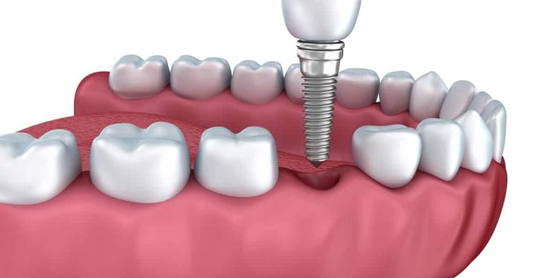 Παρενέργειες Εμφυτευμάτων