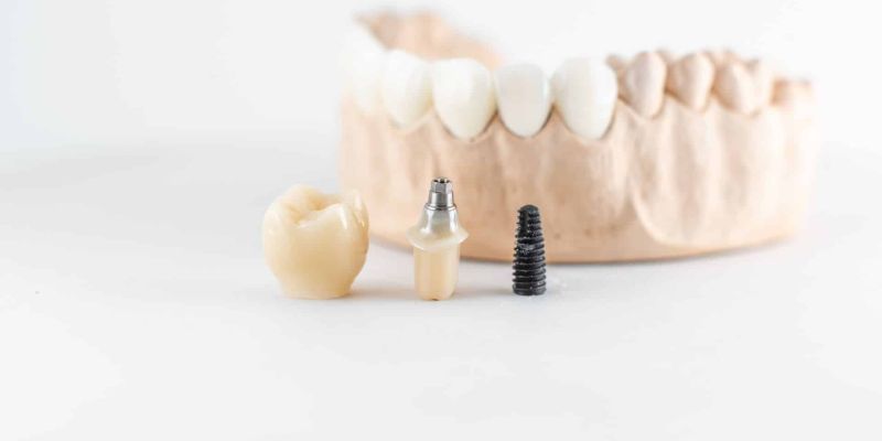 εμφυτεύματα δοντιών