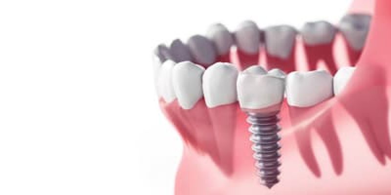 Εμφυτεύματα Δοντιών