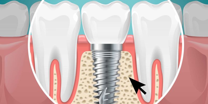 Οστική Ανάπλαση για Οδοντικά Εμφυτεύματα
