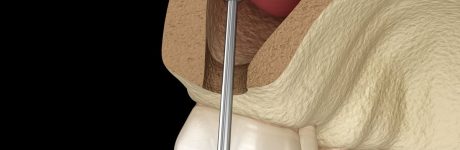 Ανύψωση Ιγμορείου