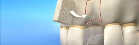 bone-graft
