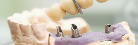 Γέφυρες Θήκες με Εμφυτεύματα