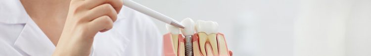 Εμφυτεύματα δοντιών - Γενικές Οδηγίες