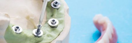 Ζυγωματικά Εμφυτεύματα